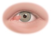 the best treatment for pterygium at the Best eye clinic in Bangalore